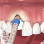 Endodontist for Specialized Tooth&nbsp;Preservation