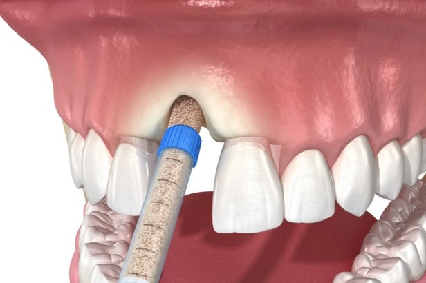 Endodontist for Specialized Tooth&nbsp;Preservation